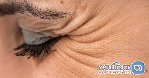 چطور از چین و چروک های پنجه کلاغی جلوگیری کنیم؟ چطور از چین و چروک های پنجه کلاغی جلوگیری کنیم؟